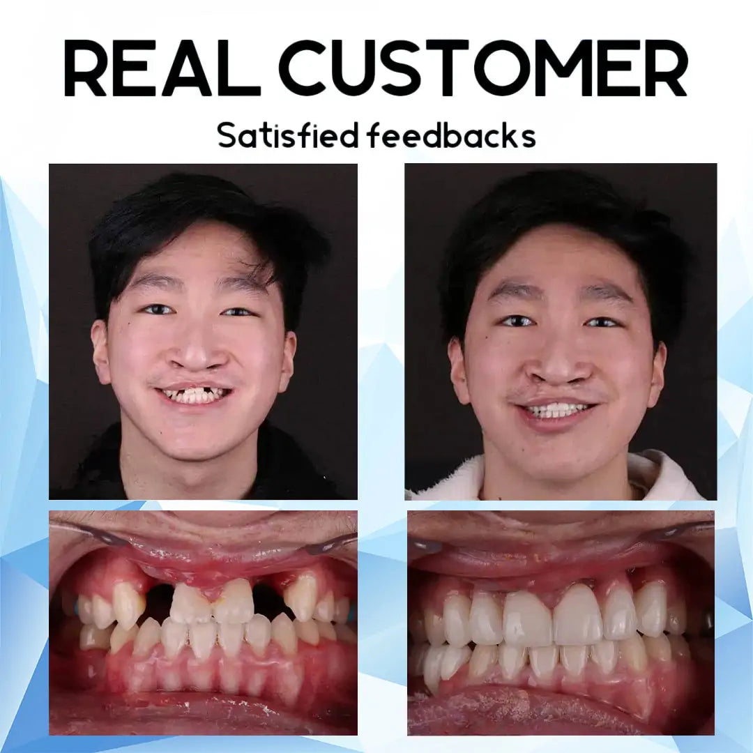 🦷 QIAWI™-Premium Custom Silicone Denture Set 👨‍⚕️ American Dental Association (ADA) certified